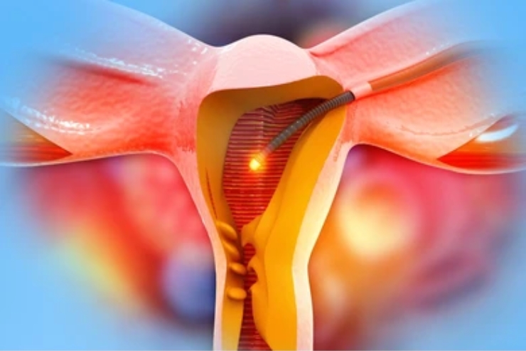 Laparoscopic Extra Fascial Hysterectomy